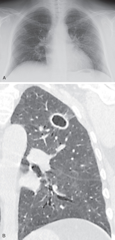 Fig. 46.4, Granulomatosis with polyangiitis: cavitary nodules. (A) Chest radiograph shows bilateral thin-walled cavitary nodules. (B) Coned-down coronal reformatted CT image demonstrates thin-walled left upper lobe cavitary nodule, with mild surrounding ground-glass opacities suggestive of hemorrhage.