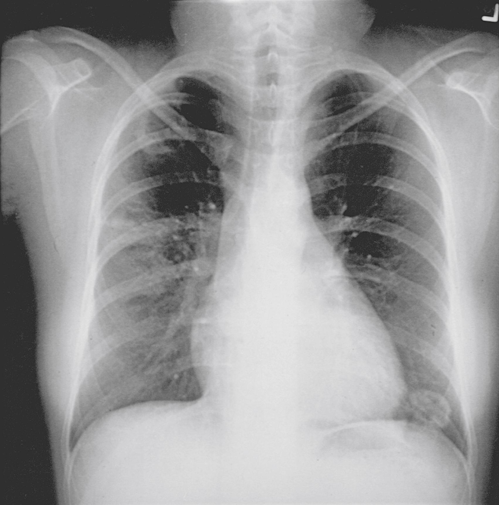 Fig. 36.4, Patchy, lower lobe infiltrates and several well-defined granulomata ( left, lower lobe; right, upper and middle lobes) are evident in the lung of an adolescent with granulomatosis with polyangiitis.