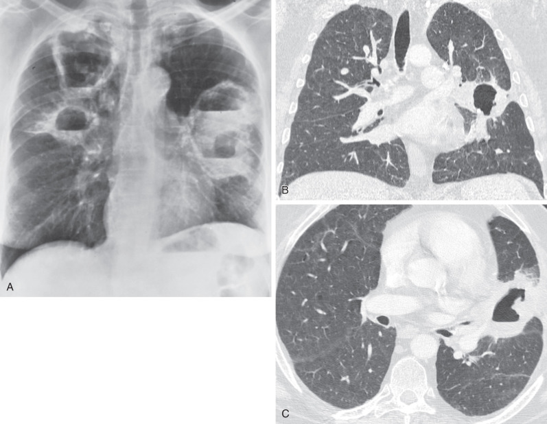 Fig. 46.5, Granulomatosis with polyangiitis: cavitating nodules and masses. (A) Posteroanterior chest radiograph shows multiple large thick-walled cavities with air-fluid levels. The left upper lung zone is oligemic, suggesting the possibility of compromise of the left upper lobe bronchus and resulting hypoxic vasoconstriction. (B) Coronal reformatted CT image from a different patient shows a thick-walled cavitary mass in the left upper lobe perihilar region. (C) CT image from the same patient as (B) shows an air-fluid level within the cavitary mass .