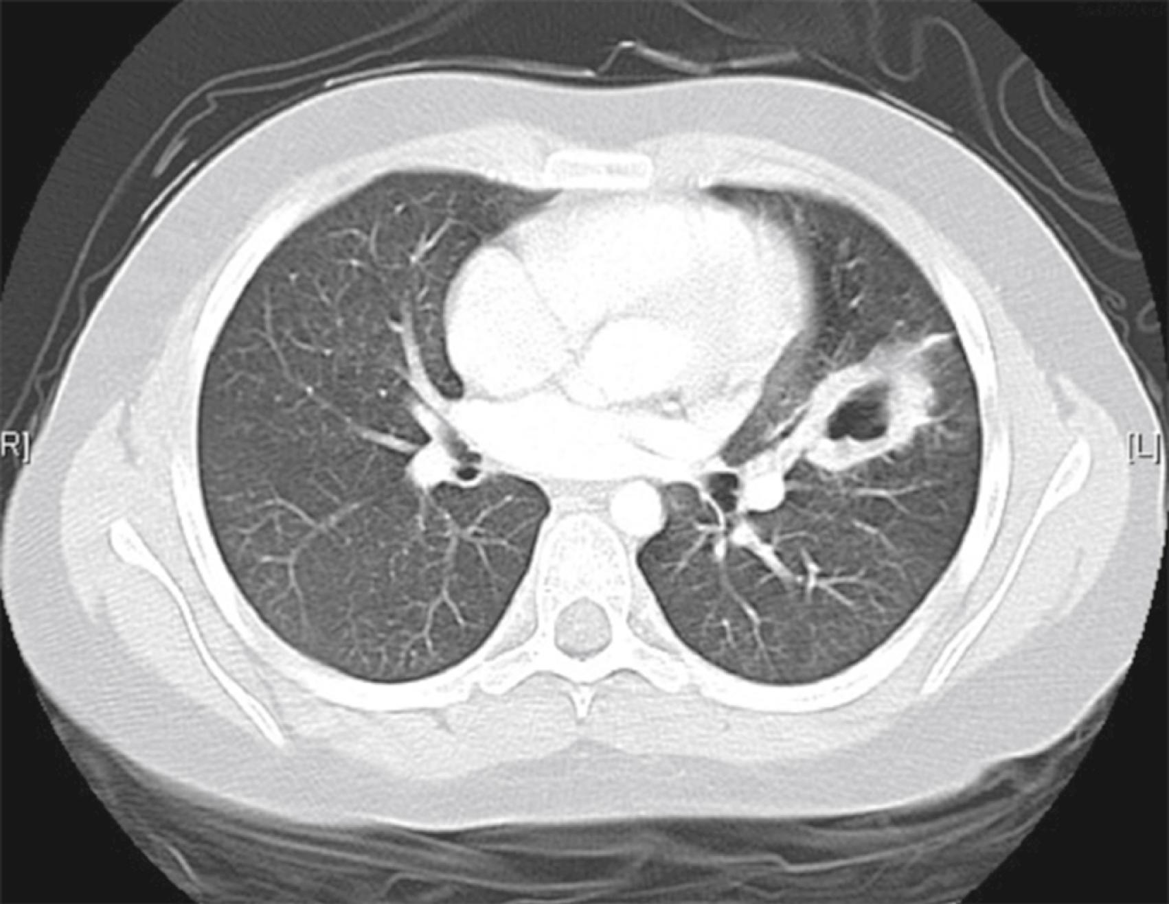 Fig. 36.5, Cavitating lung disease and main bronchus stenosis in a child with granulomatosis with polyangiitis.