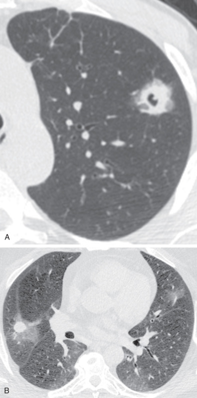 Fig. 46.6, Granulomatosis with polyangiitis: CT halo sign. (A) CT image shows peripheral cavitary nodule in the left upper lobe surrounded by a halo of ground-glass opacity. (B) CT image at the level of the minor fissure shows a noncavitary right upper lobe nodule with surrounding halo of ground-glass opacity. Foci of left upper and bilateral lower lobe ground-glass opacities likely represent pulmonary hemorrhage.