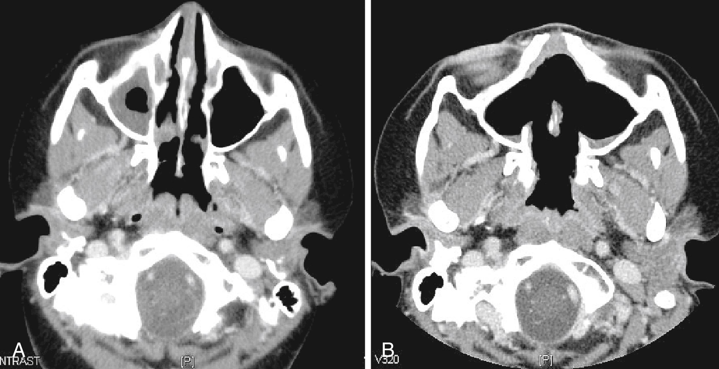 Fig. 36.6, Erosive sinusitis in a 12-year-old girl with granulomatosis with polyangiitis. Computed tomography of the sinuses in ( A ) September 2008 and ( B ) October 2009, showing almost complete destruction of the medial walls of the maxillary sinuses bilaterally.