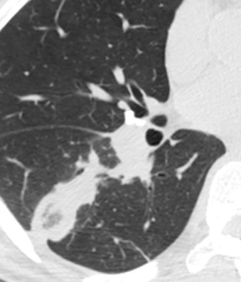 Fig. 46.7, Granulomatosis with polyangiitis: reversed halo sign. CT image shows ground-glass opacity with rim of surrounding consolidation. Histopathologic analysis of these types of nodules usually show central hemorrhage and a rim of organizing pneumonia reaction pattern.