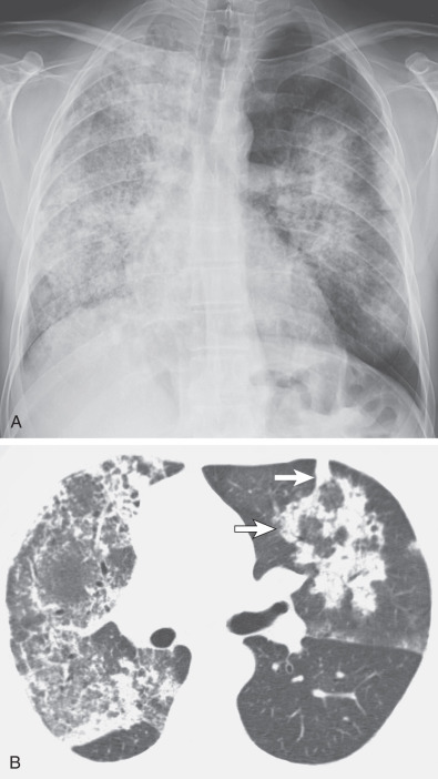 Fig. 46.8, Granulomatosis with polyangiitis: ground-glass opacities and consolidation. Chest radiograph (A) and CT image (B) show asymmetric bilateral ground-glass opacities and areas of consolidation. On CT the consolidation in the left upper lobe has a perilobular distribution of consolidation (arrows) that surrounds ground-glass opacities, a finding consistent with organizing pneumonia secondary to pulmonary hemorrhage.