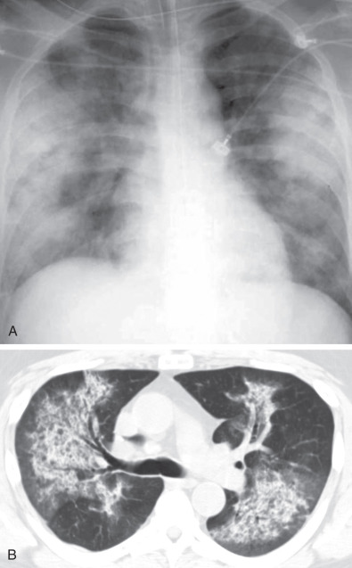 Fig. 46.9, Granulomatosis with polyangiitis: pulmonary hemorrhage. (A) Chest radiograph shows perihilar predominant consolidation that spares the lung apices and bases. (B) Axial CT image shows perihilar predominant consolidation and ground-glass opacities that spare the lung periphery, which is typical of pulmonary hemorrhage.