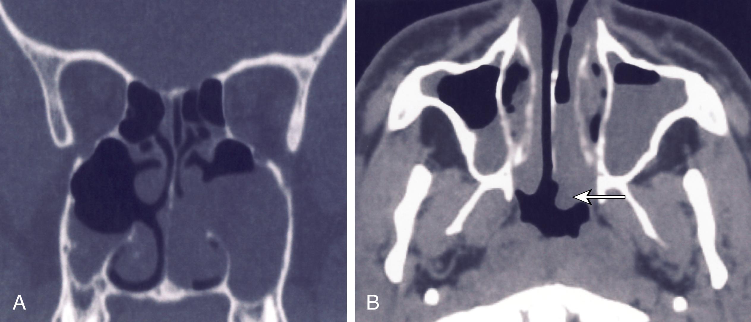 Antral Lavage Endoscopic Middle Meatal Antrostomyantrochoanal Polyp Clinical Tree 0419