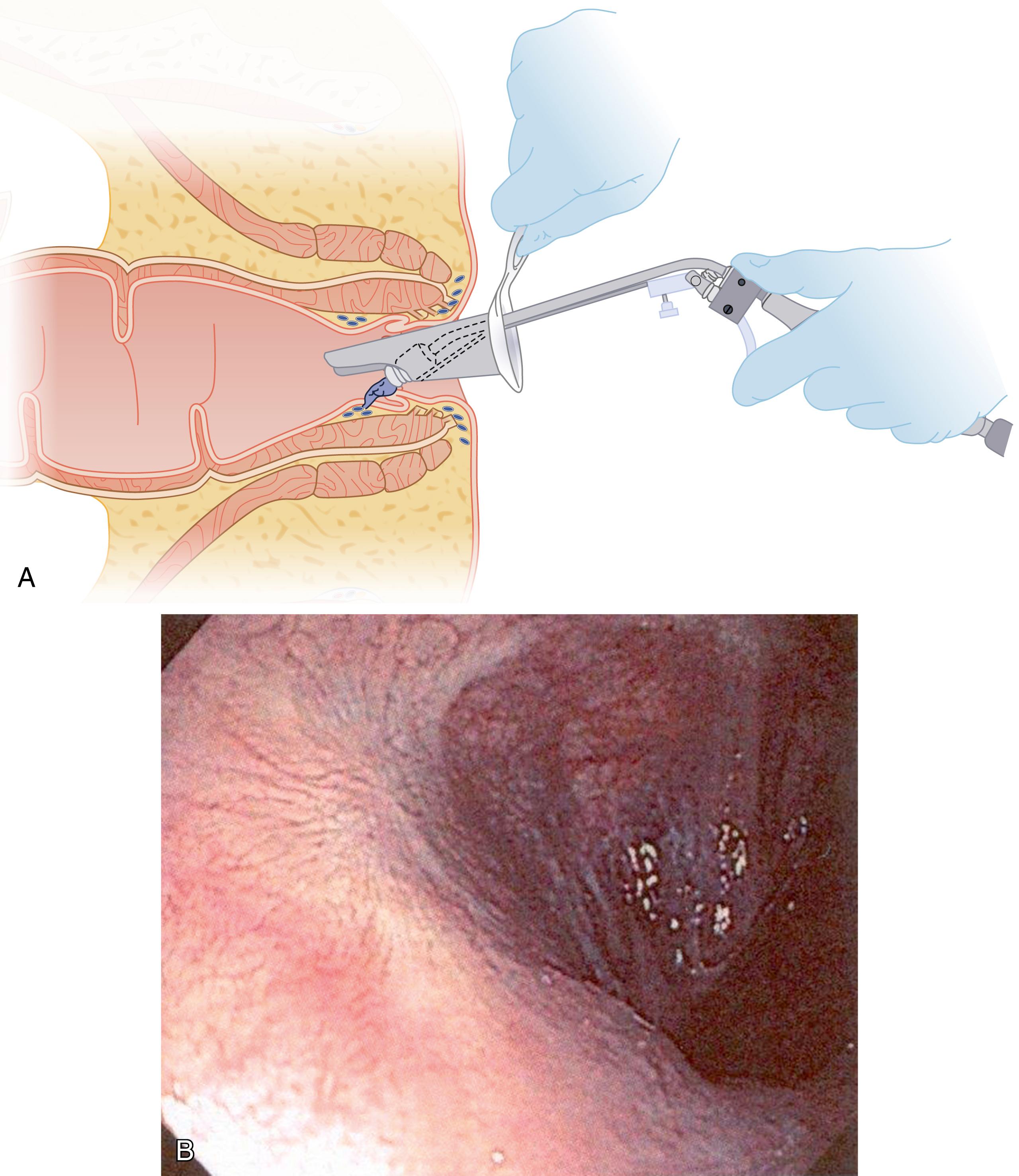 Fig. 53.2, (A) Placement of band on hemorrhoid using specially designed applicator. (B) Mucosal scarring after rubber band ligation, colonoscopic retroflexion.