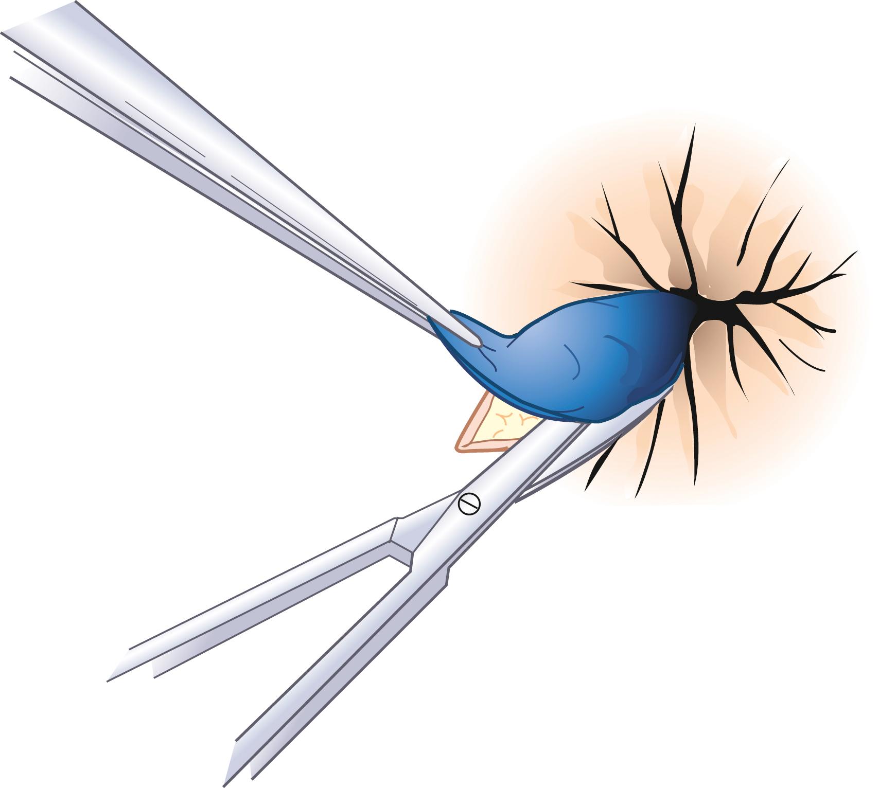 Fig. 53.4, Excision of thrombosed hemorrhoid.