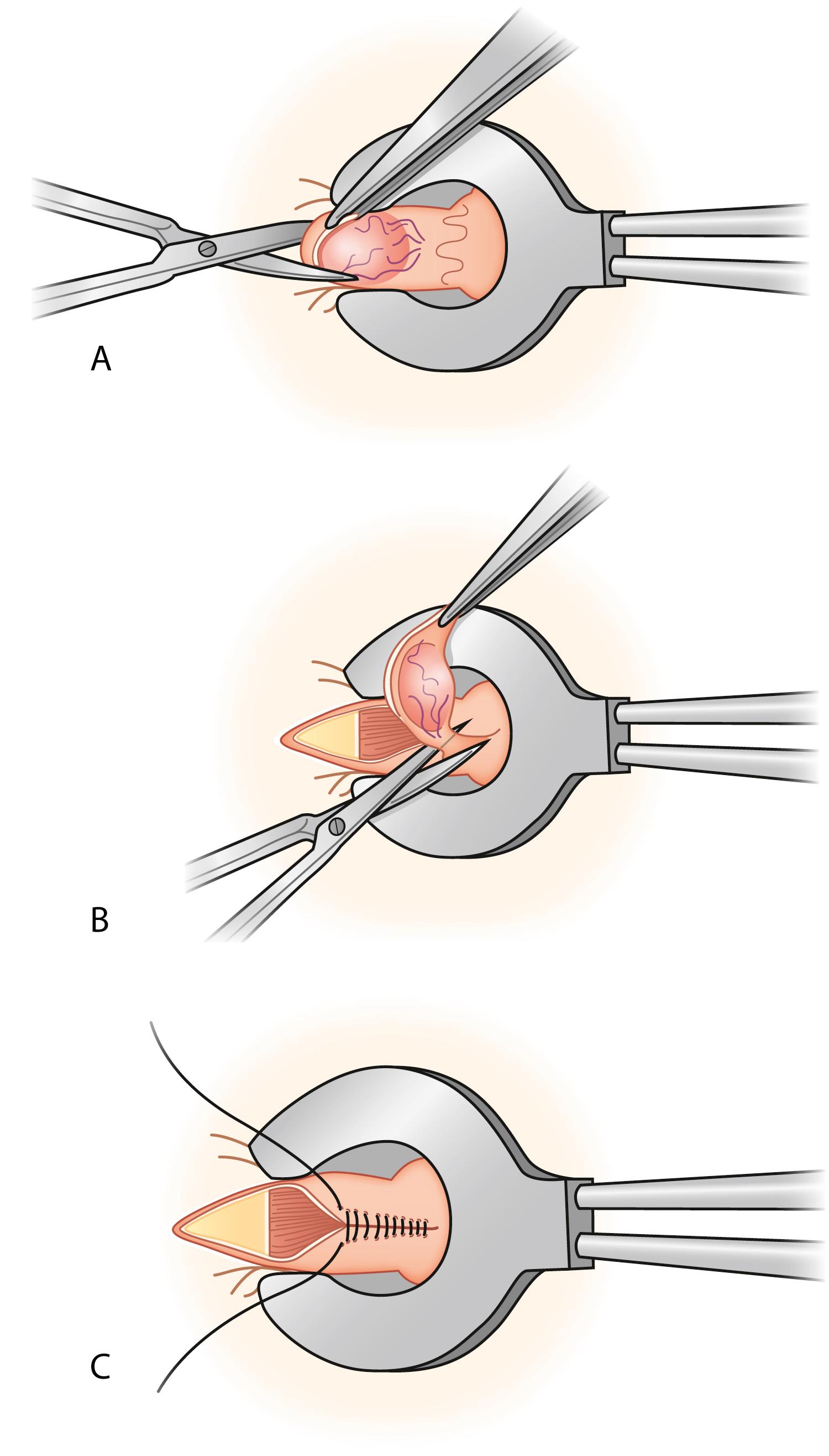 Fig. 53.5, Closed hemorrhoidectomy (Ferguson).