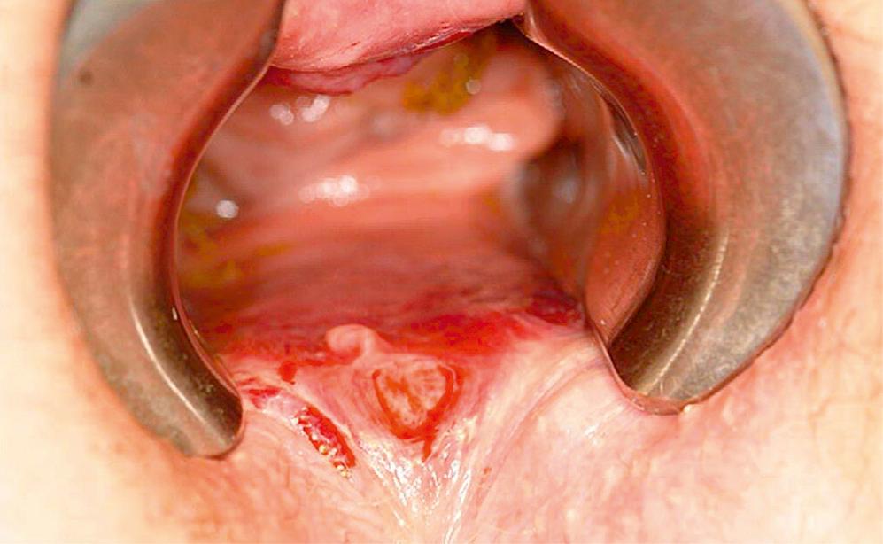 Fig. 53.6, Anal fissure.