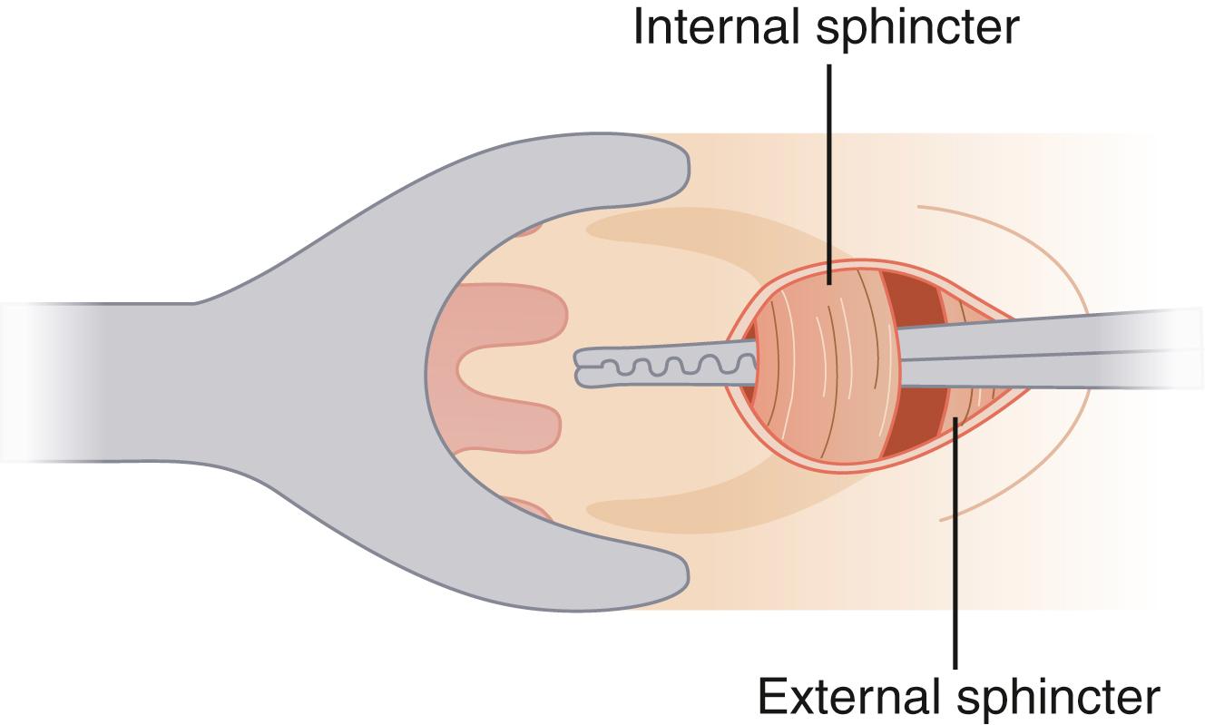 Fig. 53.8, Lateral internal sphincterotomy.