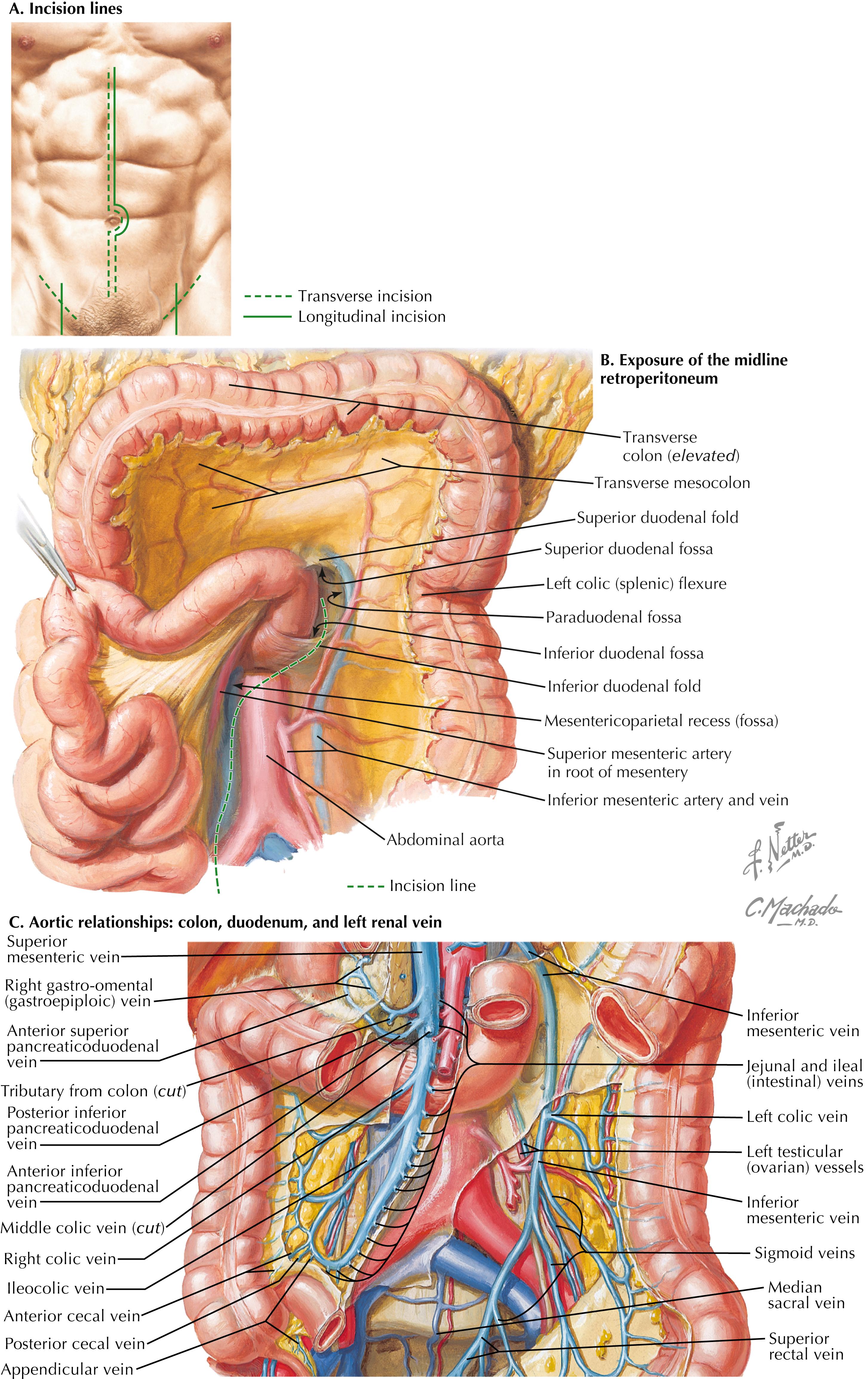 FIGURE 43.1, Abdominal incision lines and exposure of midline transperitoneal approach.