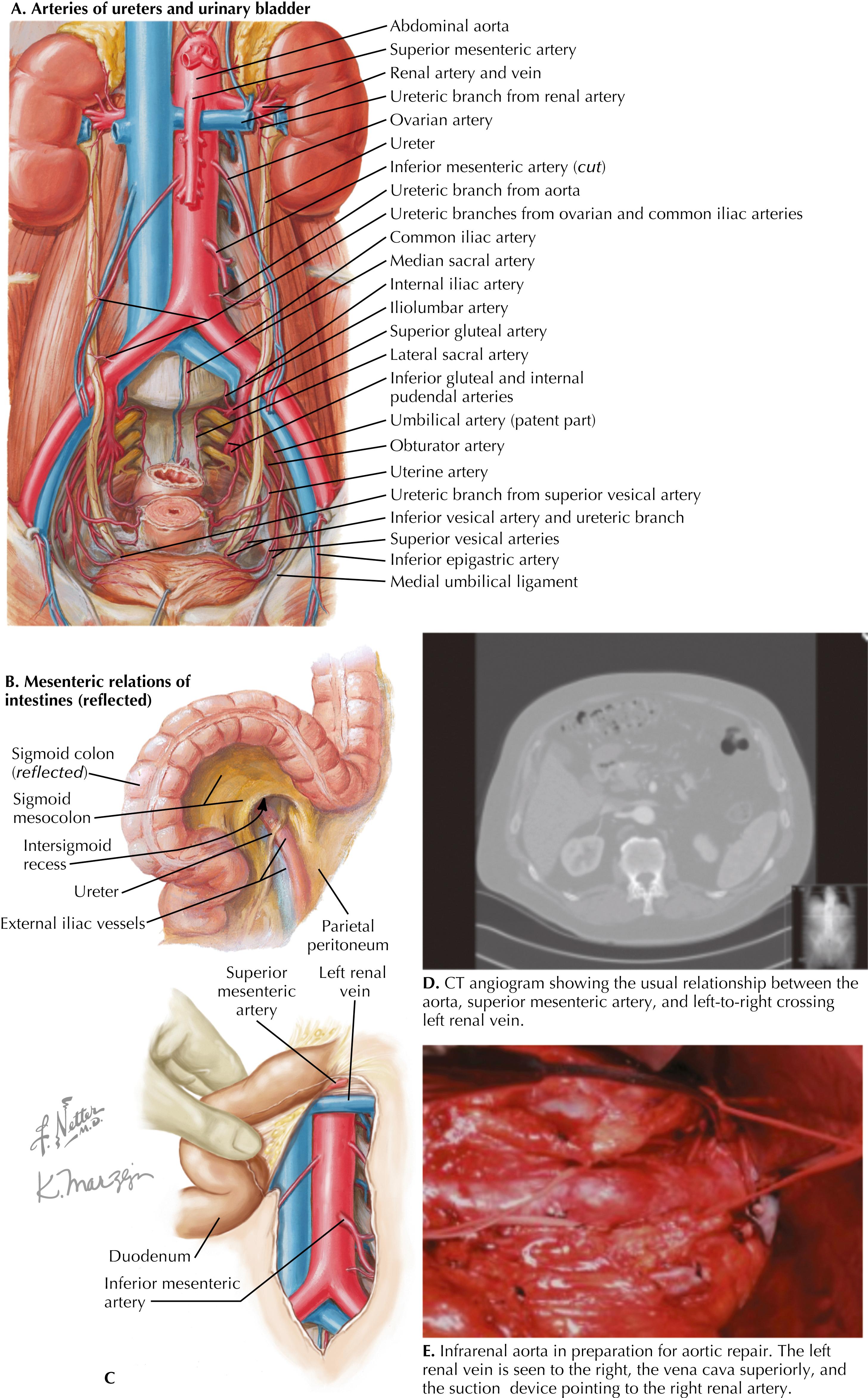FIGURE 43.2, Aortic and iliac arterial relationships with retroperitoneal structures.