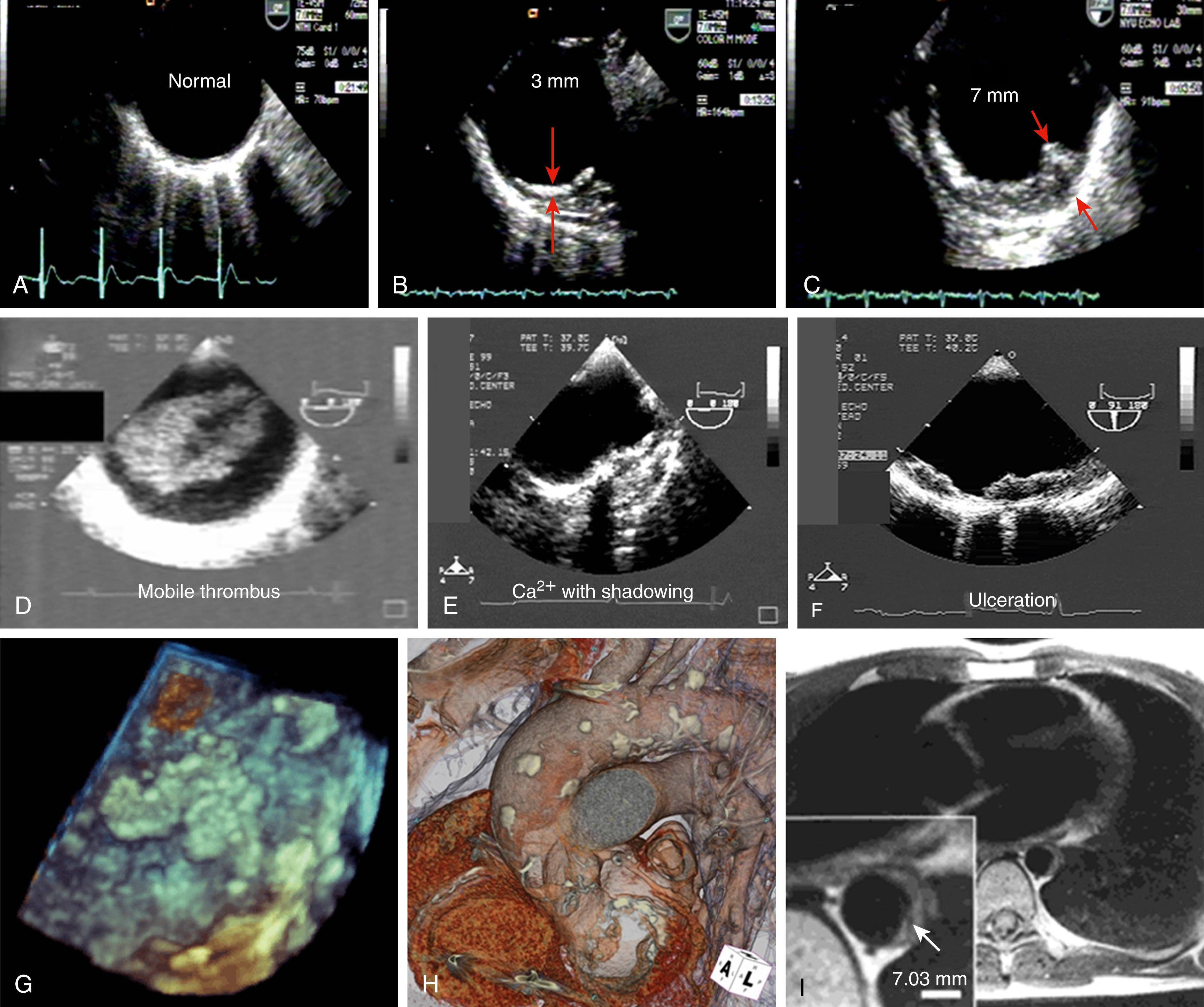 Figure 130.1, Transesophageal echocardiography shows a normal aortic intima ( A ), mild plaque ( B, red arrows ), severe plaque ( C, red arrows ), large superimposed thrombus ( D ), calcification ( E ), and ulceration ( F ). G , Three-dimensional transesophageal echocardiographic image shows the distribution, shape, and size of aortic arch plaques. H , Cardiac computed tomography demonstrates the distribution of aortic calcified plaques. I , Magnetic resonance imaging shows severe descending aortic plaque. Note the relatively lucent lipid core (arrow) .