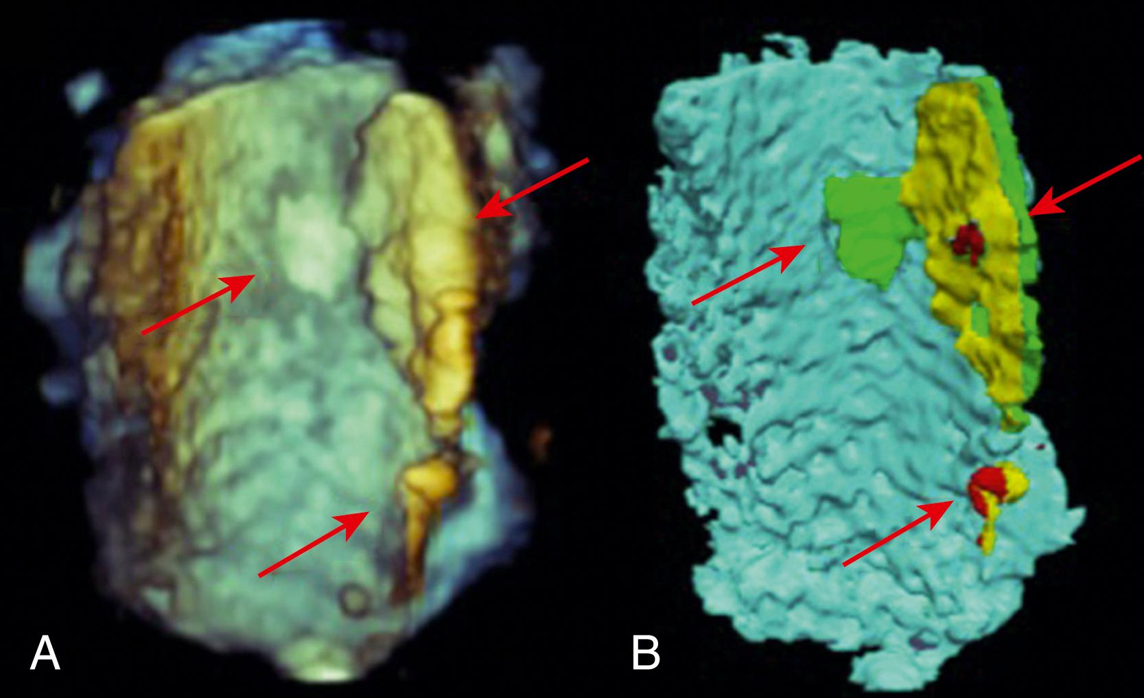 Figure 130.2, A, Three-dimensional transesophageal echocardiographic image of a diseased aorta. B, Processed image of the diseased aorta using an automated analysis software to analyze the characteristics of the plaque. Red arrows indicate atherosclerotic plaques