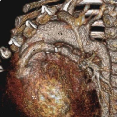 Figure 49-5, Volume-rendered image from a cardiac gated computed tomography angiogram of a 4-month-old boy born with hypoplastic left heart physiology who had undergone a Norwood first-stage repair. A neoaorta (NA) is constructed from native pulmonary trunk and connected to descending aorta without obstruction or distortion. Pulmonary circulation is provided through a right ventricular (RV) -to–pulmonary trunk small conduit (S) . There is mild narrowing in distal conduit as it enters pulmonary trunk.