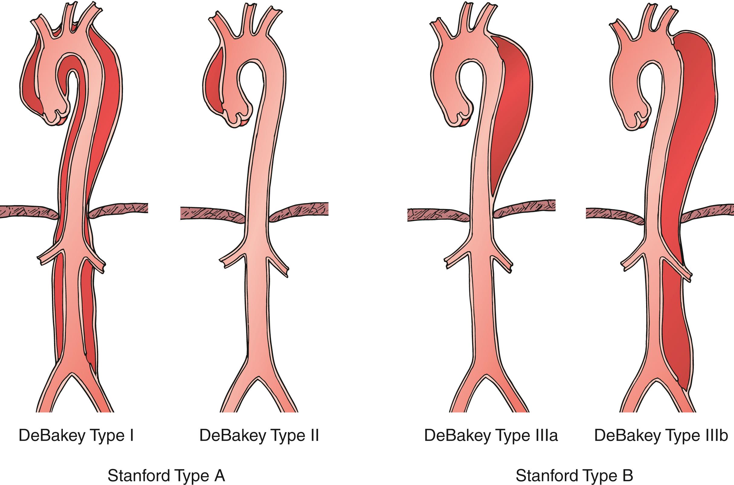 Figure 83.1, Acute aortic dissection can be classified by the original DeBakey system based on location of proximal tear and distal extent of the dissection flap, or the Stanford system that uses location of proximal tear alone.