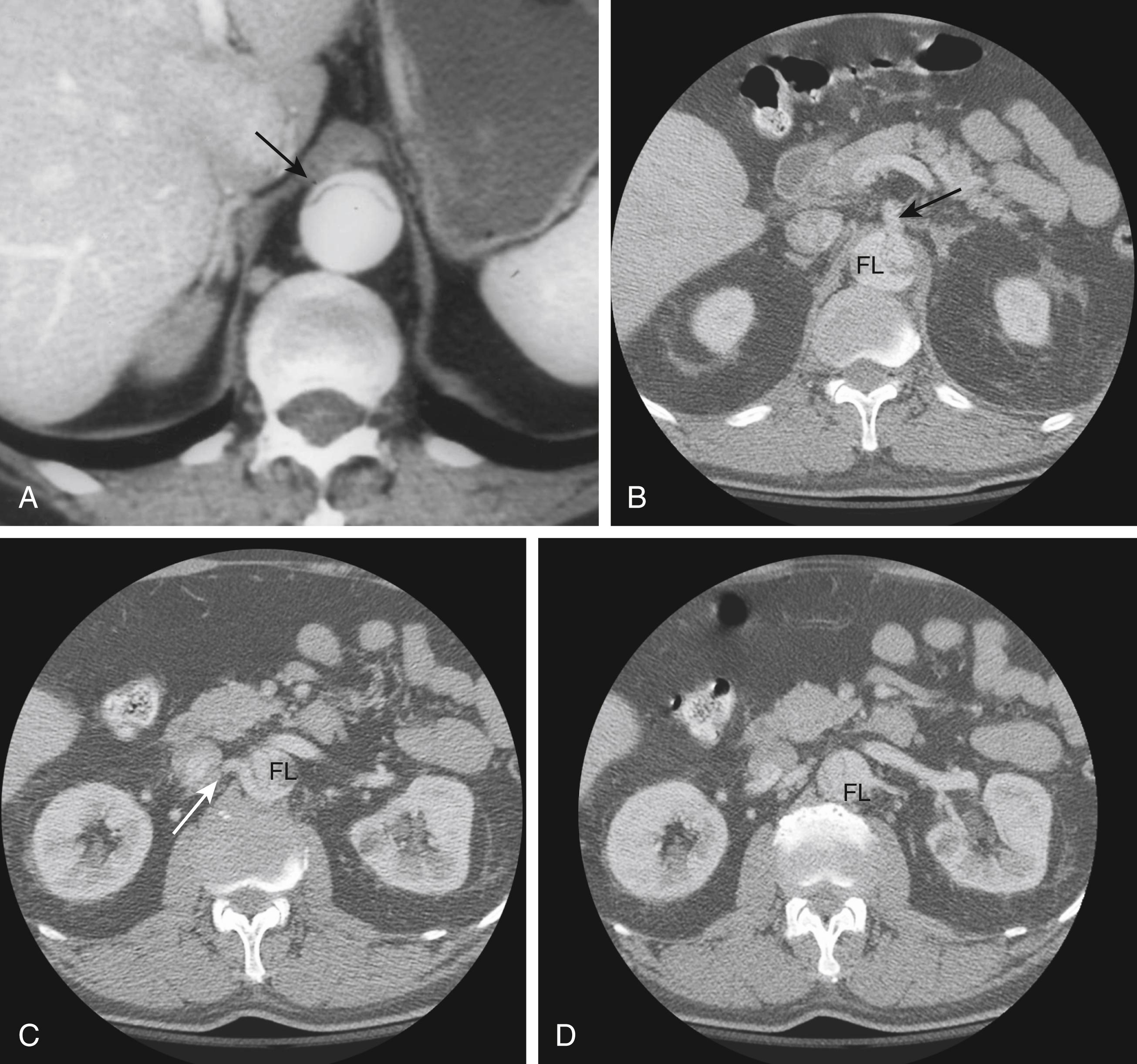 Figure 83.2, Computed Tomography Angiogram Findings of Acute Aortic Dissection.