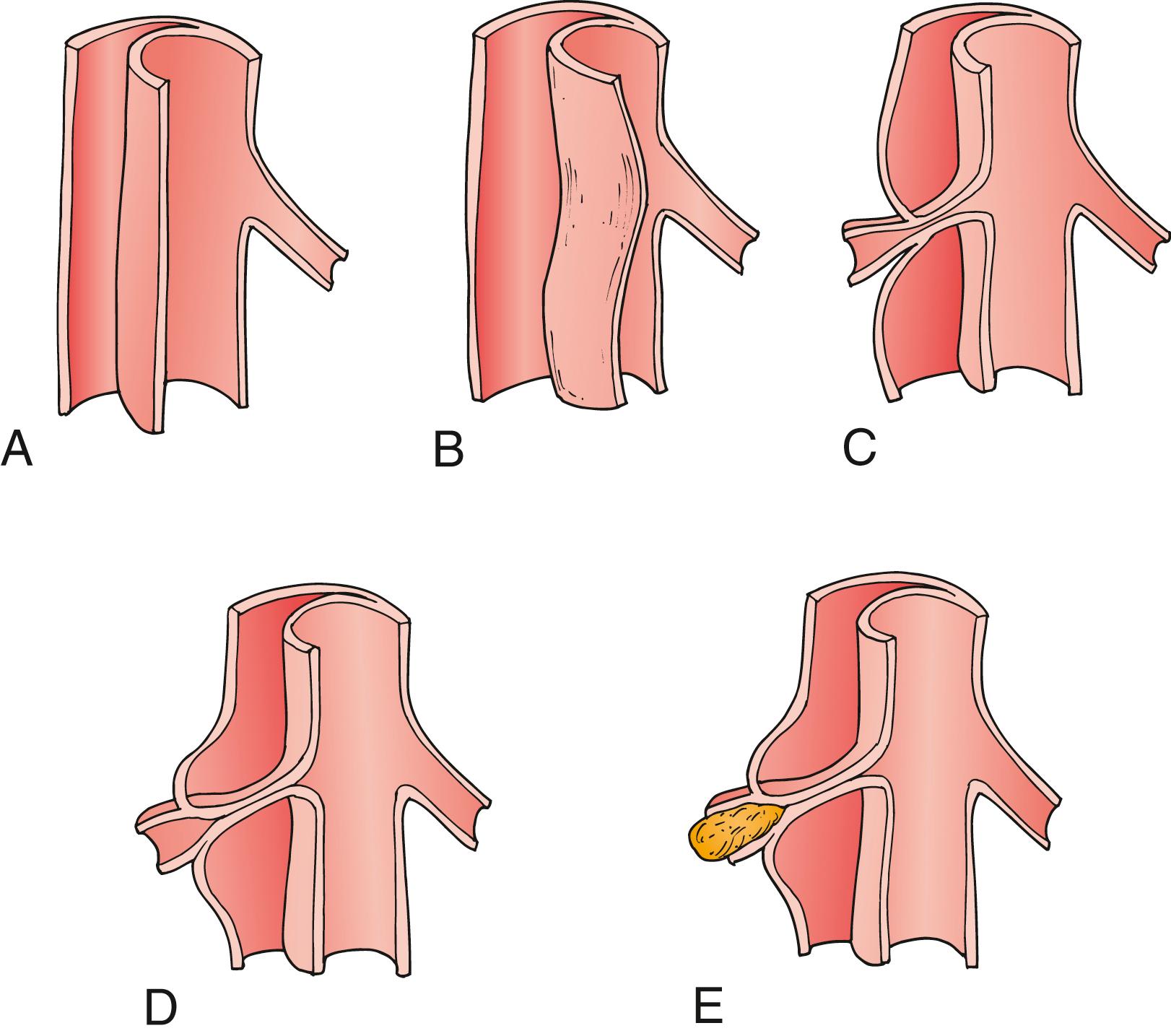 Figure 83.3, Mechanisms of Aortic Branch Obstruction in Acute Dissection.