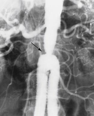 FIGURE 4, Proximal anastomotic stenosis of an aortofemoral graft (arrow).