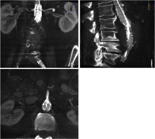 Fig. 79.1, On-table intra-procedural cone beam computed tomography angiogram following a standard endovascular aneurysm repair procedure showing no endoleak.