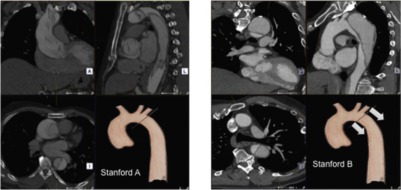 Fig. 79.13, Stanford Classification of Aortic Dissection.