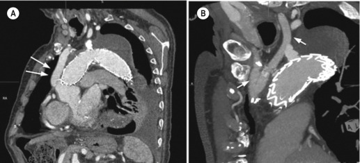 Fig. 79.14, Proximal Arch Aneurysm Treated by Complete Aortic Debranching and Stent-Grafting.