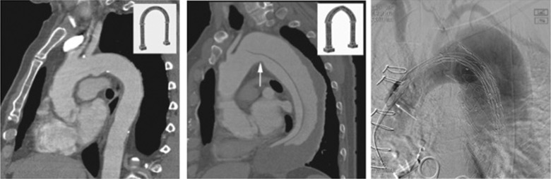 Fig. 79.15, Aortic Arch Configurations for Thoracic Endovascular Aneurysm Repair.