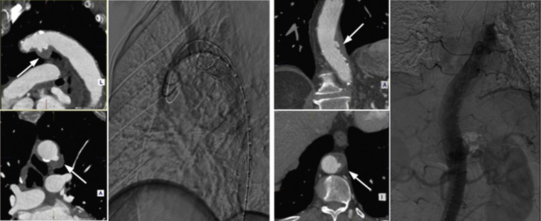 Fig. 79.16, Thoracic Aortic Ulcer.