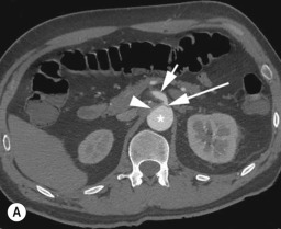 Fig. 79.17, Static and Dynamic Branch Vessel Occlusion.