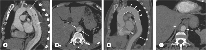 Fig. 79.18, Coverage of the Proximal Entry Tear of a Dissection With False Lumen Thrombosis and Collapse.