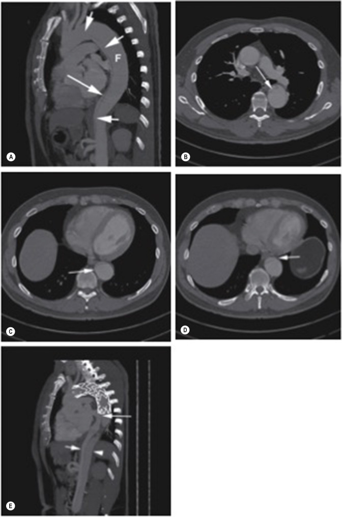 Fig. 79.19, Coverage of the Proximal Entry Tear of a Dissection With Failure of False Lumen Thrombosis and Ongoing Perfusion.