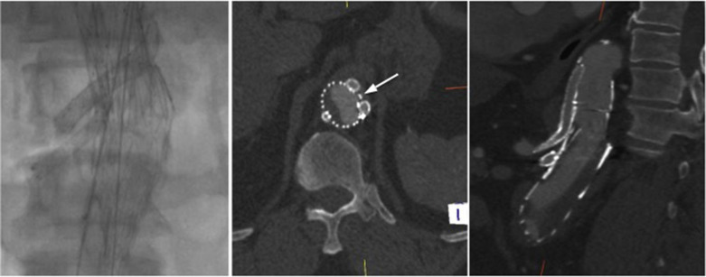 Fig. 79.4, Parallel Stent-Grafts.