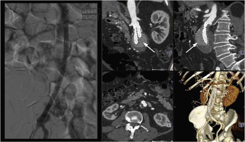 Fig. 79.5, Endovascular Aneurysm Repair Using Endovascular Sac Anchoring System Device.