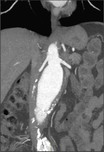 Fig. 79.6, Adverse Anatomy for Endovascular Aneurysm Repair.