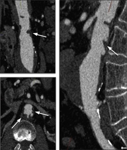 Fig. 79.7, Adverse Anatomy for Endovascular Aneurysm Repair.