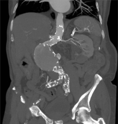 Fig. 79.8, Adverse Anatomy for Endovascular Aneurysm Repair.