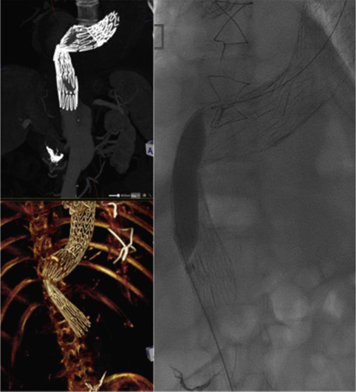 Fig. 79.9, Complications of Endovascular Aneurysm Repair (Management).