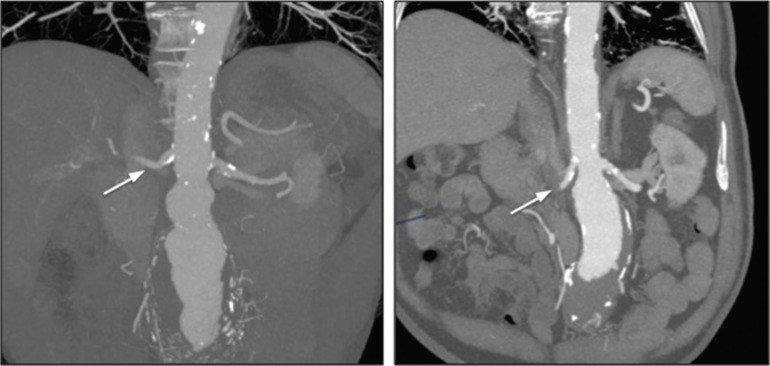 Fig. 79.10, Adverse Anatomy for Endovascular Aneurysm Repair.