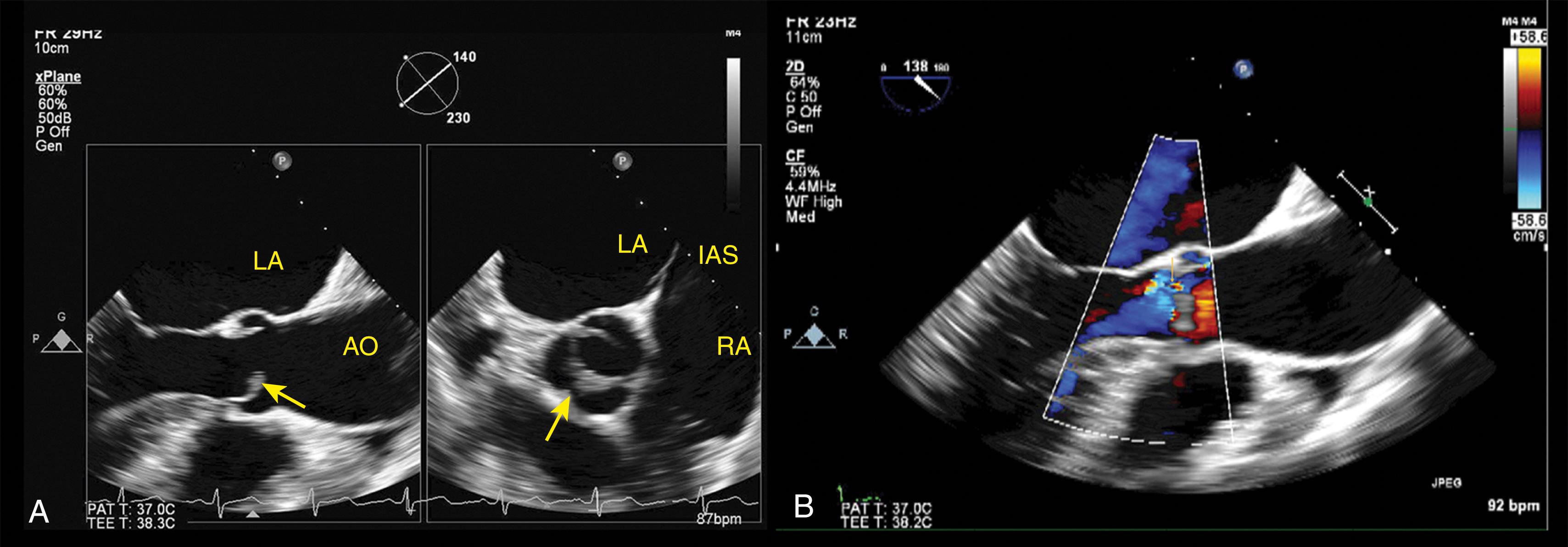 Figure 86.1, Two-dimensional and color Doppler images of a bicuspid aortic valve. Midesophageal transesophageal echocardiography (TEE) long-axis view with X-plane at the level of the aortic valve ( A ) demonstrates doming of the leaflet (arrow) , and the X-plane short-axis view demonstrates a bicuspid aortic valve with fusion of the right and left coronary cusp with a raphe (arrow) with fish-mouth appearance of valve orifice. TEE long-axis view of the aortic valve with color Doppler ( B ). The aortic regurgitation jet is eccentric (arrow) . AO, Aorta; IAS, interatrial septum; LA, left atrium; RA, right atrium. (See accompany Video 86.1 ).