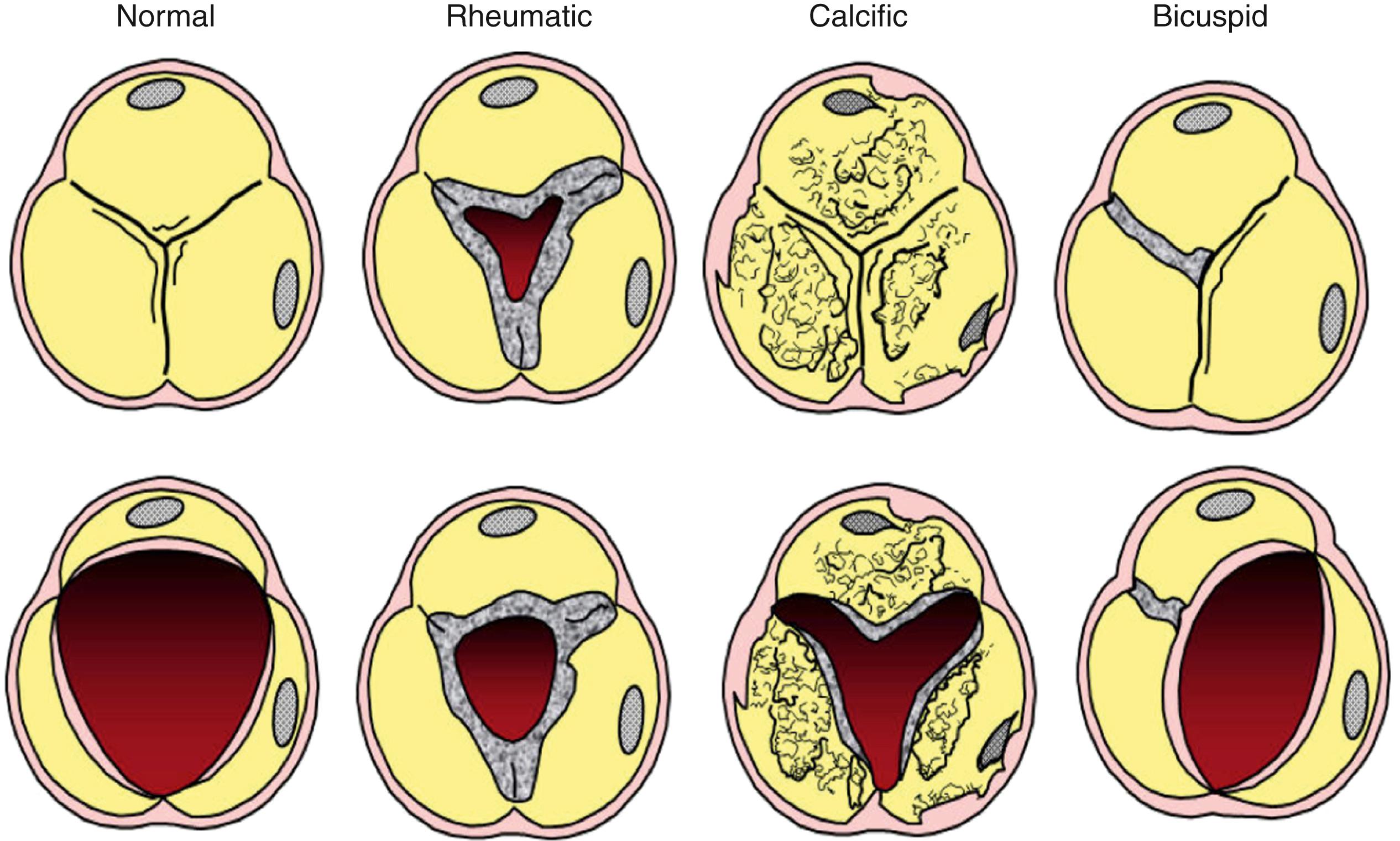 Figure 78.1, Diagram illustrating the diastolic (top row) and systolic (bottom row) appearances of a normal aortic valve and the three common causes of valvular aortic stenosis.