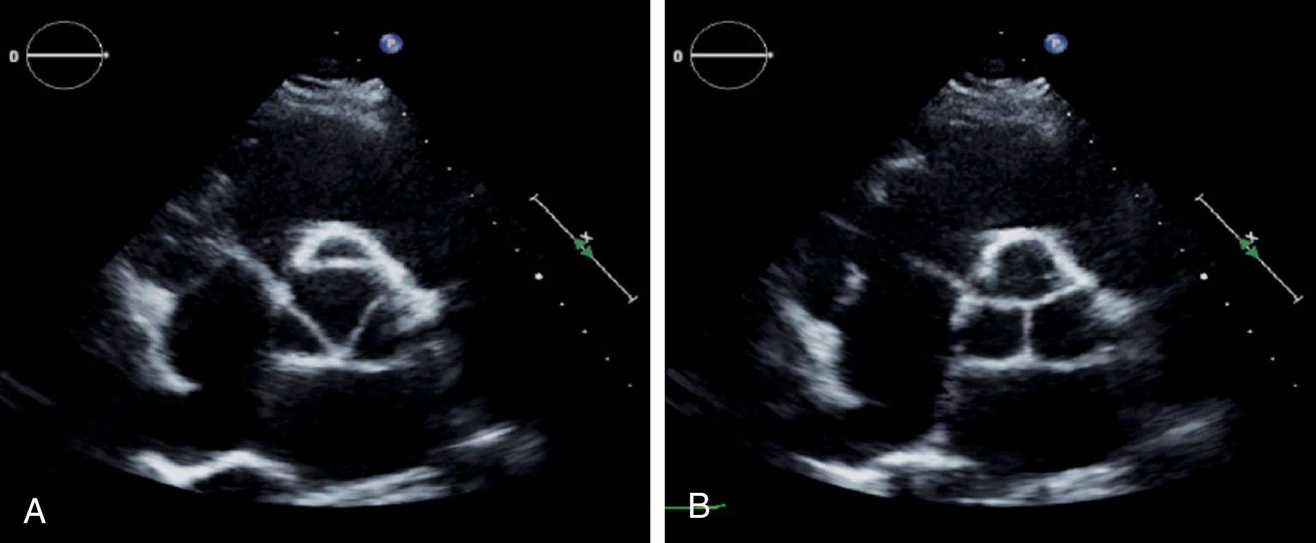 Figure 78.2, Transthoracic echocardiogram (short-axis view) of a normal tricuspid aortic valve. A, In diastole, the normal trileaflet valve appears like a Y with the commissures at the 10, 2, and 6 o’clock positions. B, In systole, the valve opens in a triangular fashion with straightening of the leaflets.