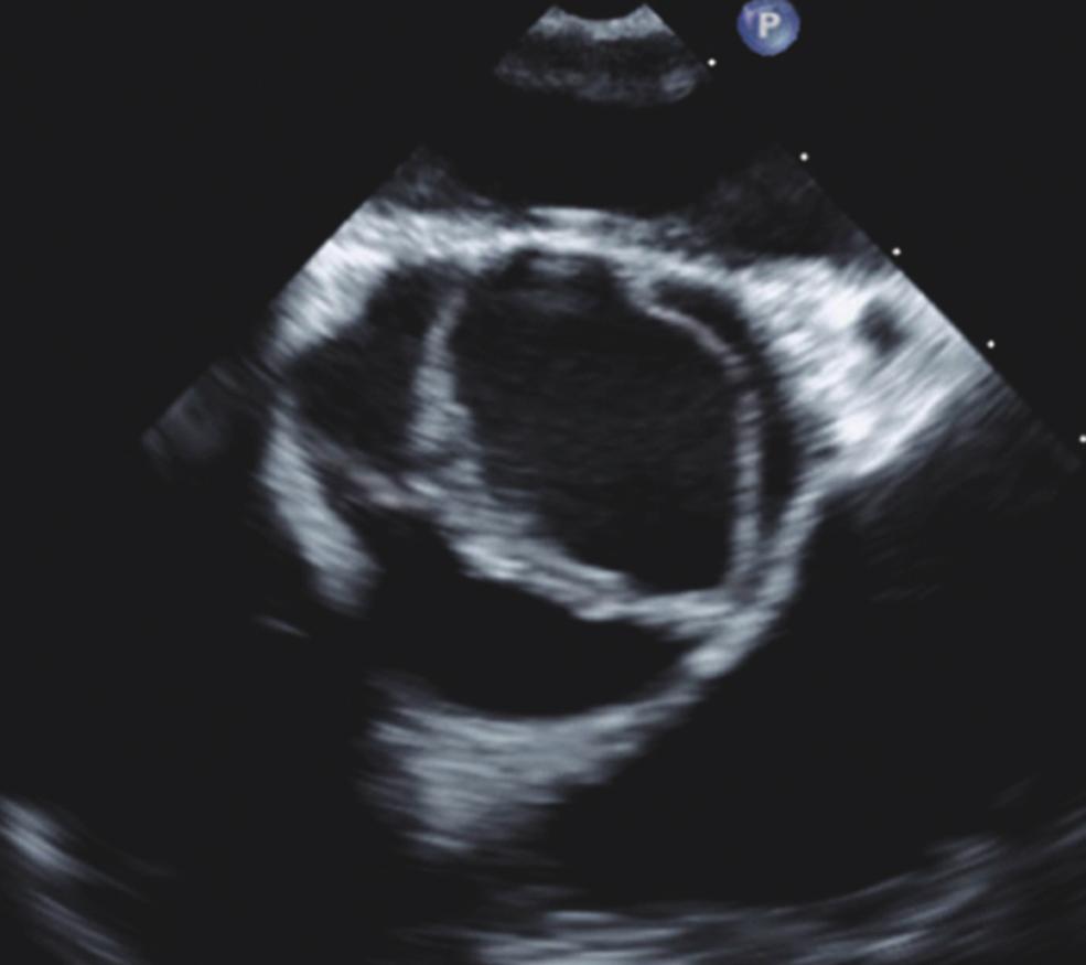 Figure 78.3, Transesophageal echocardiogram (cross section) of a bicuspid aortic valve illustrating the elliptical (“fish-mouth” or “football”) shape with curvilinear leaflets in systole.