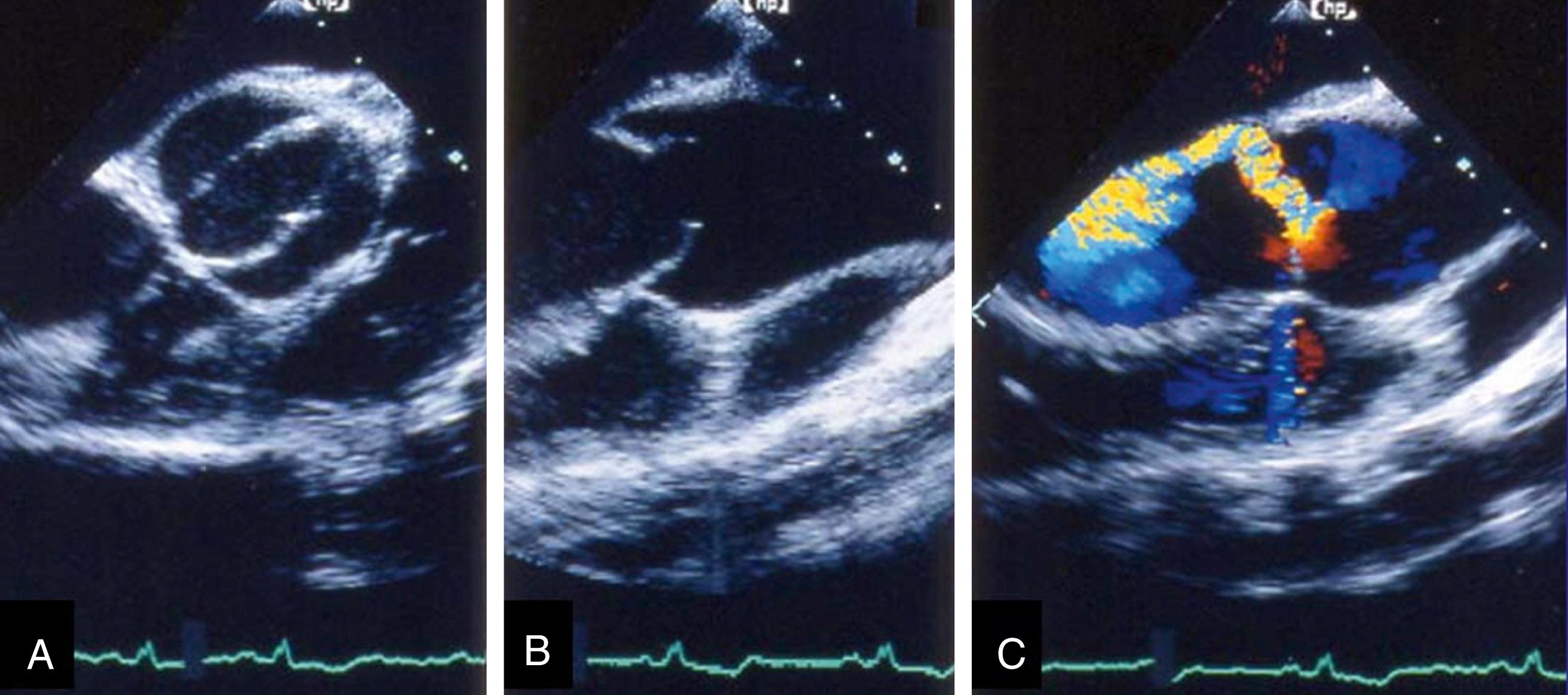 Figure 78.4, Bicuspid aortic valve. A, Short-axis view shows “fish-mouth” or football-shaped opening. B, Long-axis view shows systolic doming. C, Color Doppler shows eccentric aortic regurgitant jet (typical of bicuspid aortic valve).