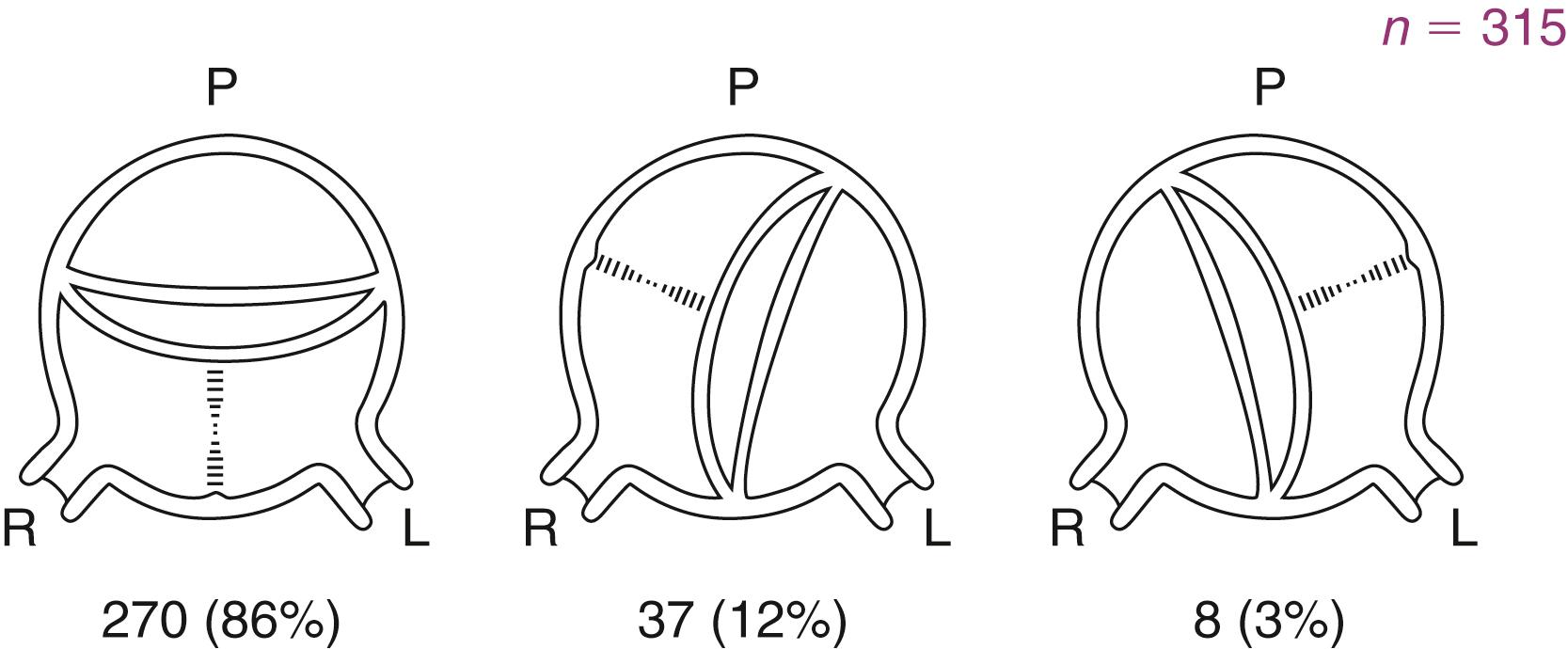 Figure 78.5, Variations in bicuspid valves. Relative positions of raphe and conjoined cusp. L, Left; P, Posterior; R, right.