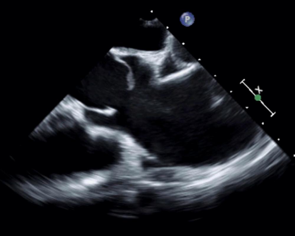 Figure 78.6, Transesophageal echocardiographic longitudinal view of the aortic root and ascending aorta illustrating the systolic doming of a bicuspid aortic valve.