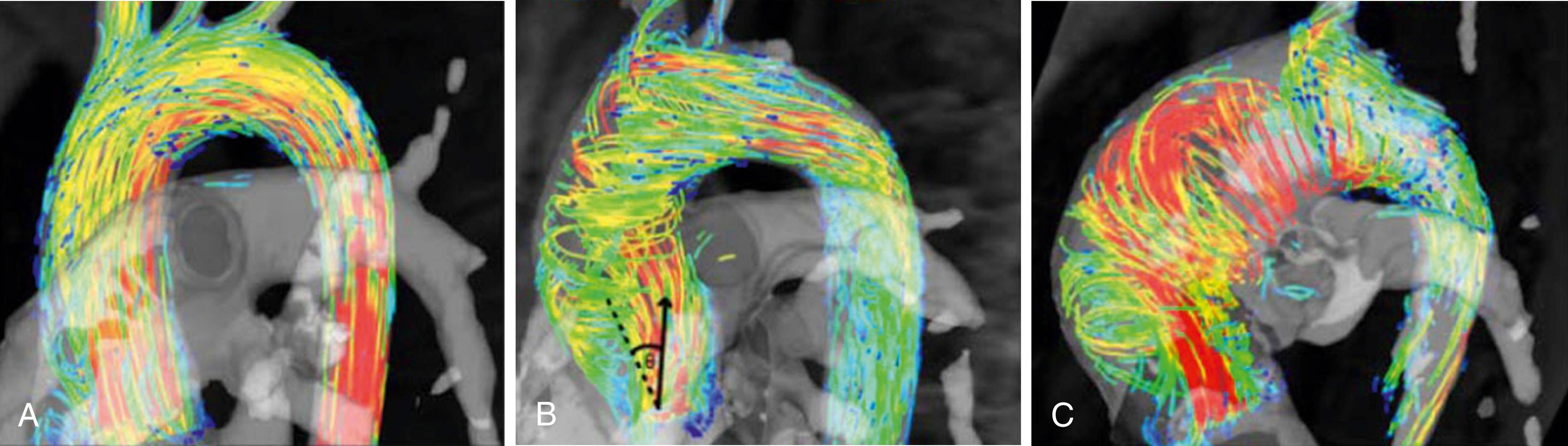Figure 78.8, Flow patterns in bicuspid aortic valve disease. A, Normal flow pattern. B , Right-handed helical flow. C, Left-handed helical flow. The systolic flow angle (θ) is demonstrated in B : the angle between the aortic midline (dashed) and the instantaneous mean flow vector at peak systole (arrow) .