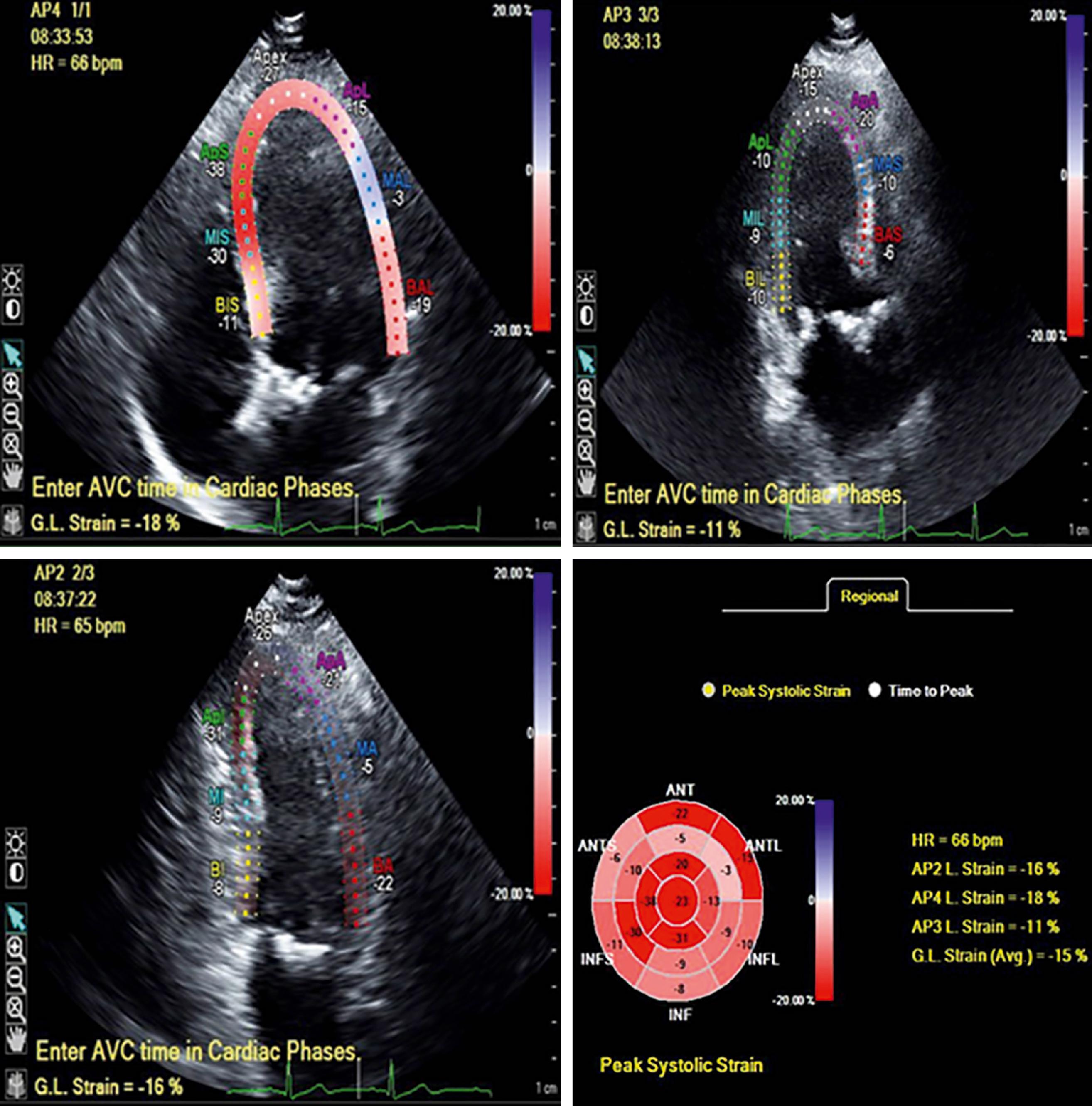 Figure 81.2, Reduced left ventricular global longitudinal strain in a patient with severe aortic stenosis and left ventricular ejection fraction of 62%. AVC, Aortic valve closure; GL, global longitudinal; HR, heart rate.