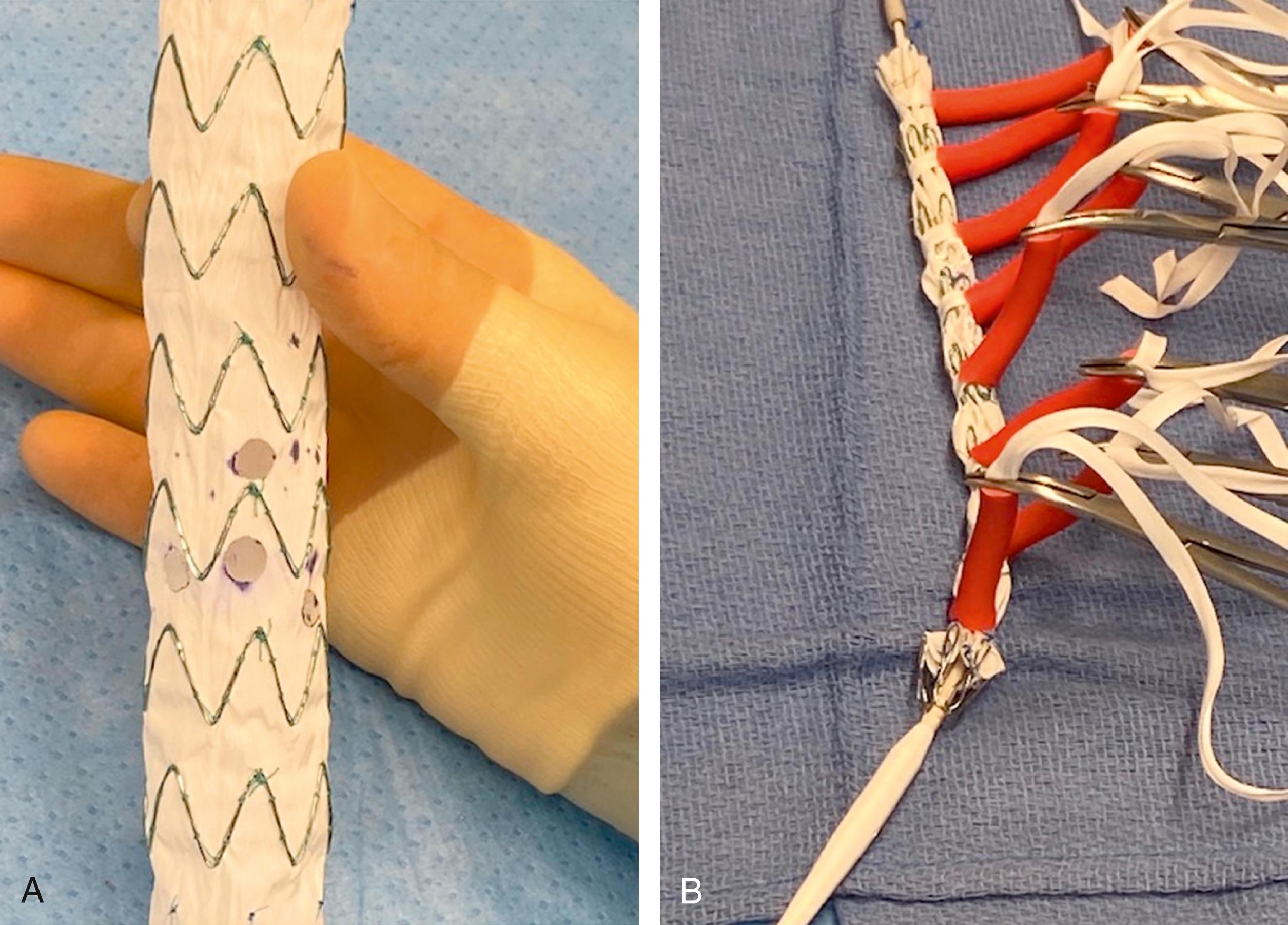 Figure 81.1, ( A ) Eye cautery is used to create a four-vessel fenestrated physician-modified endograft (PMEG) on a Cook Alpha endograft. ( B ) A series of Rummel tourniquets with umbilical tape and red rubber catheters are used to reconstrain the PMEG device into the delivery system.