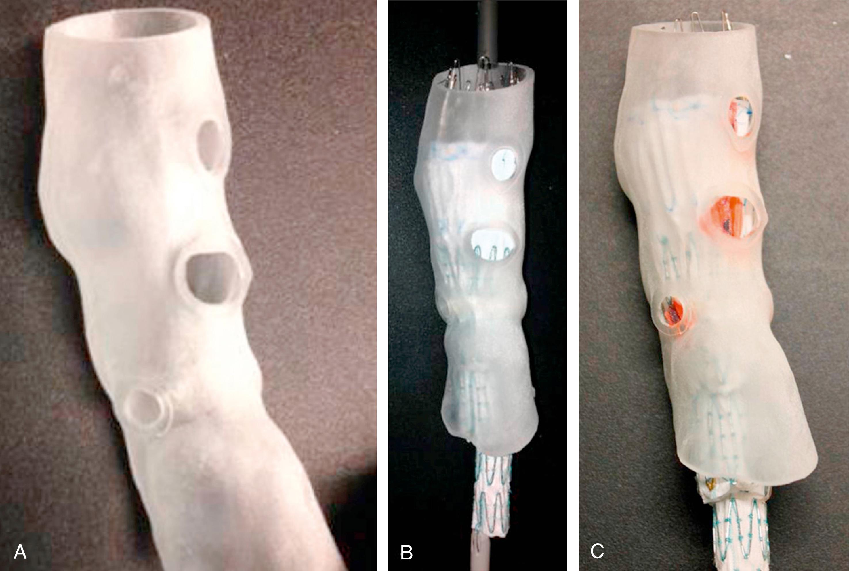 Figure 81.2, Three-dimensional (3D) printing has been shown to facilitate PMEG construction. ( A ) 3D printed model of the aorta with fenestrations for branch vessel origins. ( B ) Aortic endograft deployed within the 3D printed model. ( C ) Location for visceral/renal fenestrations are marked onto the endograft based on the 3D model holes.